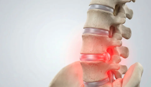 Melbourne Spine Studio | Dr Alvin Pun | Victoria | Consultation | Slipped Disc or Sciatica